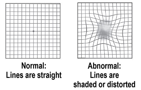 Chart Showing Normal Vision Compared to Vision With Macular Degenration
