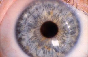 Closeup of an Eye With a Corneal Transplant