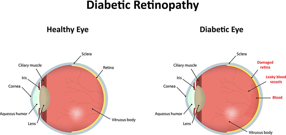 Chart Showing a Healthy Eye Compared to One With Diabetic Retinopathy