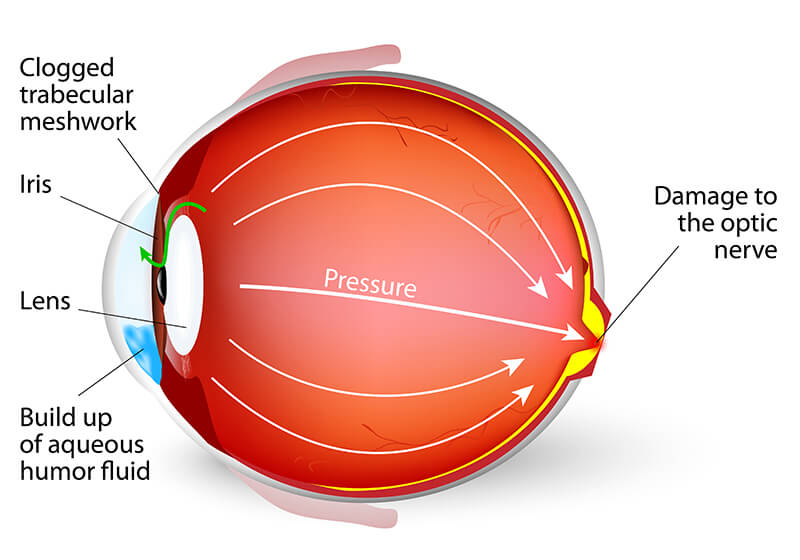 Chart Showing Glaucoma in an Eye